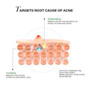 Novology Acne Reduction Cleanser + Acne Reduction Serum Combo