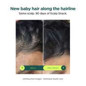 RESOLVE Scalp Snack Hair Growth and Scalp Renewal Serum Combo