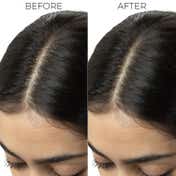 Brillare Dandruff Control Shampoo for Itchy Flaky Scalp (300 ml)