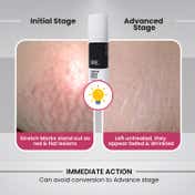 Thriveco Stretch Mark Expert Serum Cream (30ml)