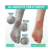 Patchology Poshpeel Pedi Cure Treatment