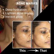 House of Beauty Acne Drying Serum For Pimpled, Oily & Open Pores Skin W-T Salicylic Acid (30 ml)