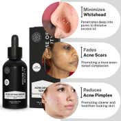 House of Beauty Acne Drying Serum For Pimpled, Oily & Open Pores Skin W-T Salicylic Acid (30 ml)