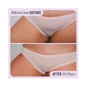 First Aid Beauty Ingrown Hair Treatment Pads - (28 Pcs)