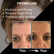House of Beauty Frownie Patches For Forehead Lines & Skin Tightening W-T Peptides (2 Pcs)