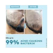 Hyphen Acne Defence Daily Serum (30 ml)