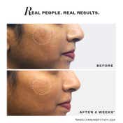 Novology Pigmentation Reduction Serum, For Acne Marks, Dark Spots, Combination-Oily Skin (30 ml)