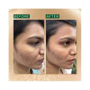 Ras Luxury Skincare Spot Corrector & Acne Marks Correcting Advanced Booster Serum (10 ml)