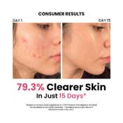 ThriveCo Acne-Free Sun Defense Kit (3 pcs)
