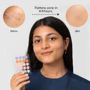 Gush Beauty Dart It Hydrocolloid Pimple Patches for Healing Acne, Zits and Blemishes - Super Star (5 Colors)