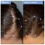 WishCare Anti Hairfall Kit with Anti Hairfall Shampoo & Conditioner Concentrate for Hair Growth