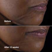 Clinique Smart Clinical Repair Lifting Face + Neck Cream (75 ml)