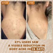 mCaffeine 7% Exfoliating and 1% Salicylic, 2% Lactic Acid Body Wash for Body Acne Reduce (300 ml)