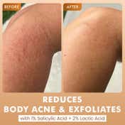 mCaffeine 7% Exfoliating and 1% Salicylic, 2% Lactic Acid Body Wash for Body Acne Reduce (300 ml)