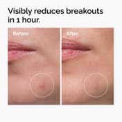 The Ordinary Sulfur 10% Powder-to-Cream Concentrate - Acne Spot Correction for Sensitive Skin (5 g)