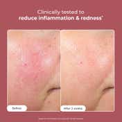 Conscious Chemist 10% Azelaic Acid Gel Cream For Redness Relief & Acne Treatment (50gm)