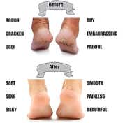 Bronson Professional Anti Crack Silicone Socks (1Pc)