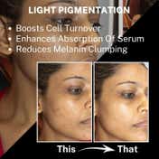 House of Beauty Derma Roller 0.50mm Reduces Pigmentation, Fade Pimples & Acne Scars (1 Pc)