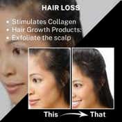 House of Beauty Derma Roller 1.00mm For Home Use, Reduces Hairfall, Balding & Stretchmarks (1 Pc)