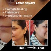 House of Beauty Acne Oil W-T Tea Tree, Avocado & Vit-E For Drying Pimpled & Oily Skin (30 ml)