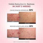 Conscious Chemist 10% Azelaic Acid Gel Cream For Redness Relief & Acne Treatment (50gm)
