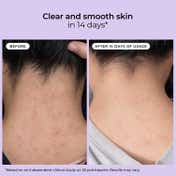 Foxtale Exfoliating Body Wash 2% Salicylic Acid Zinc PCA Reduces Body Acne Smoothens Skin (250 ml)