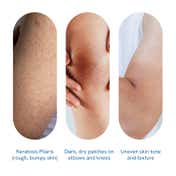 Be Bodywise 5% Lactic Acid Body Lotion For Improved Skin texture & Smooth Skin (200 ml)