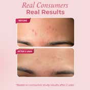 The Pink Foundry Overnight Acne Spot Corrector (30ml)