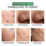 Novology Acne Spot Corrector for Active Acne Pimples and Whiteheads (30 g)