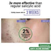 Sereko Anti Acne Calming Serum with 2% Salicylic Acid and 3% Azelaic Acid (30 ml)