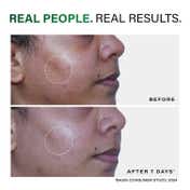 Novology Acne Clearing Cleanser for Acne Whiteheads and Blackheads for Sensitive Skin (150 g)