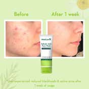 WishCare 2% Salicylic Acid Face Wash with AHA and Tea Tree Oil Control Reduces Sebum & Acne (100 ml)