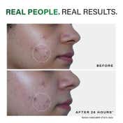 Novology Acne Spot Corrector for Active Acne Pimples and Whiteheads (30 g)