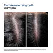 WishCare Hair Growth Serum Concentrate with Redensyl In Vivo Tested Boosts Hair Growth (30 ml)
