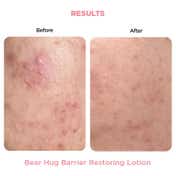 Resolve Bear Hug Barrier Restoring Lotion (50 g) - Before & After Results