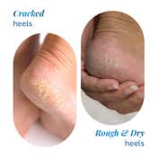 Be Bodywise 20% Urea Foot Cream Roll On (50 ml)