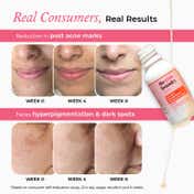 The Pink Foundry Dark Spot & Hyperpigmentation Face Serum (15 ml)