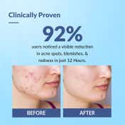 Fixderma Salyzap Acne Spot Corrector Gel with Salicylic Acid (20 g)