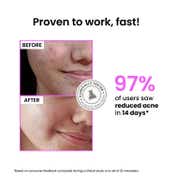 Foxtale 12% Niacinamide Serum with Azelaic Acid for Oil Control & Brightening (30 ml)