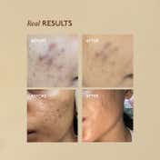 ASAYA Advanced Spot Targeting Face Serum for Dark Spots Removal & Hyperpigmentation (30 ml)