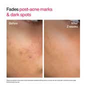WishCare Advanced Dark Spot Correcting TXA Shot Serum, Alpha Arbutin & Niacinamide (30 ml)