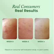The Pink Foundry Acne Care & Healing Gel Moisturiser (50ml)