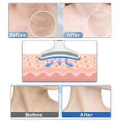 Ktein Wrinkle Remover Machine for Face Firming Wrinkle Device