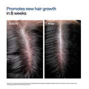 Wishcare Hair Growth Serum Concentrate Roll On - In-Vivo Tested (10 ml)
