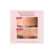 The Pink Foundry Overnight Acne Spot Corrector (15ml)