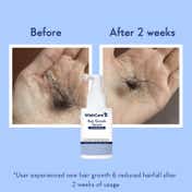 WishCare Hair Growth Serum Concentrate with Redensyl In Vivo Tested Boosts Hair Growth (20 ml)