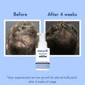 WishCare Hair Growth Serum Concentrate with Redensyl In Vivo Tested Boosts Hair Growth (20 ml)