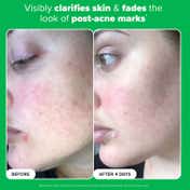 PAULA'S CHOICE Boost 10% Azelaic Acid Booster (5 ml)