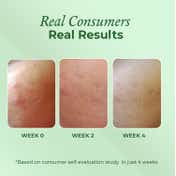 The Pink Foundry Acne Care & Healing Gel Moisturiser (50ml)