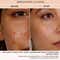 BiE Calm Your Zits - Anti Acne Gel for Spot Correction and Pimple Marks (20g)